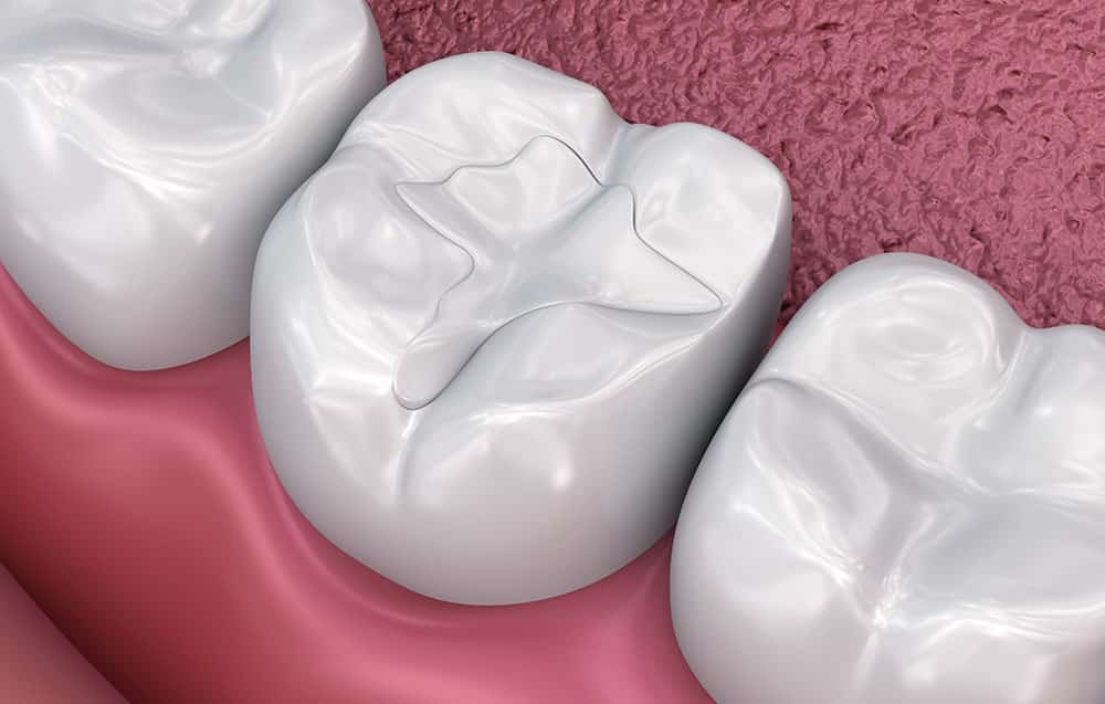 Dental filling structure